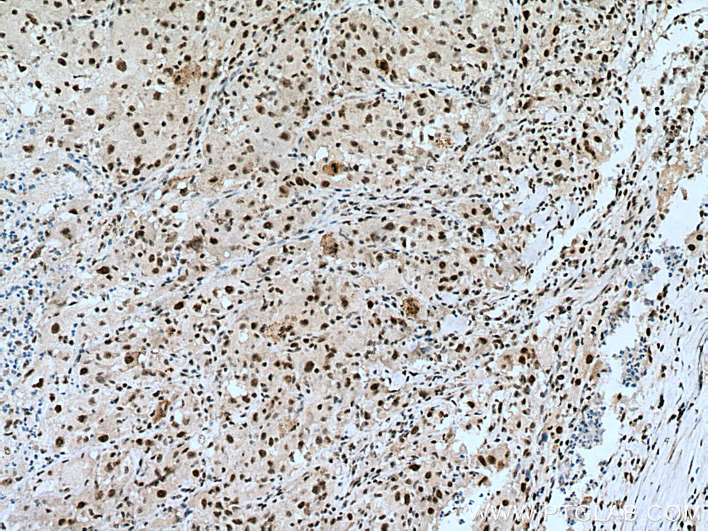 IHC staining of human liver cancer using 12615-1-AP