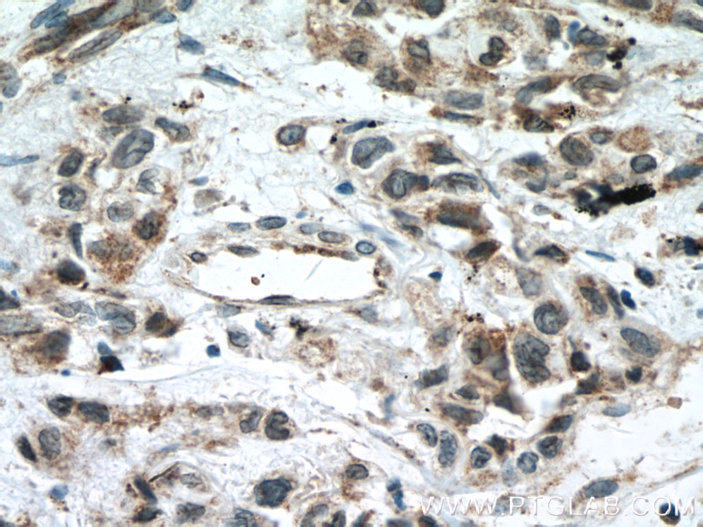 IHC staining of human lung cancer using 55030-1-AP