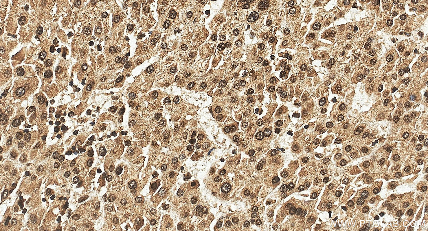 IHC staining of human liver cancer using 21166-1-AP IHC staining of human liver cancer using 21166-1-AP