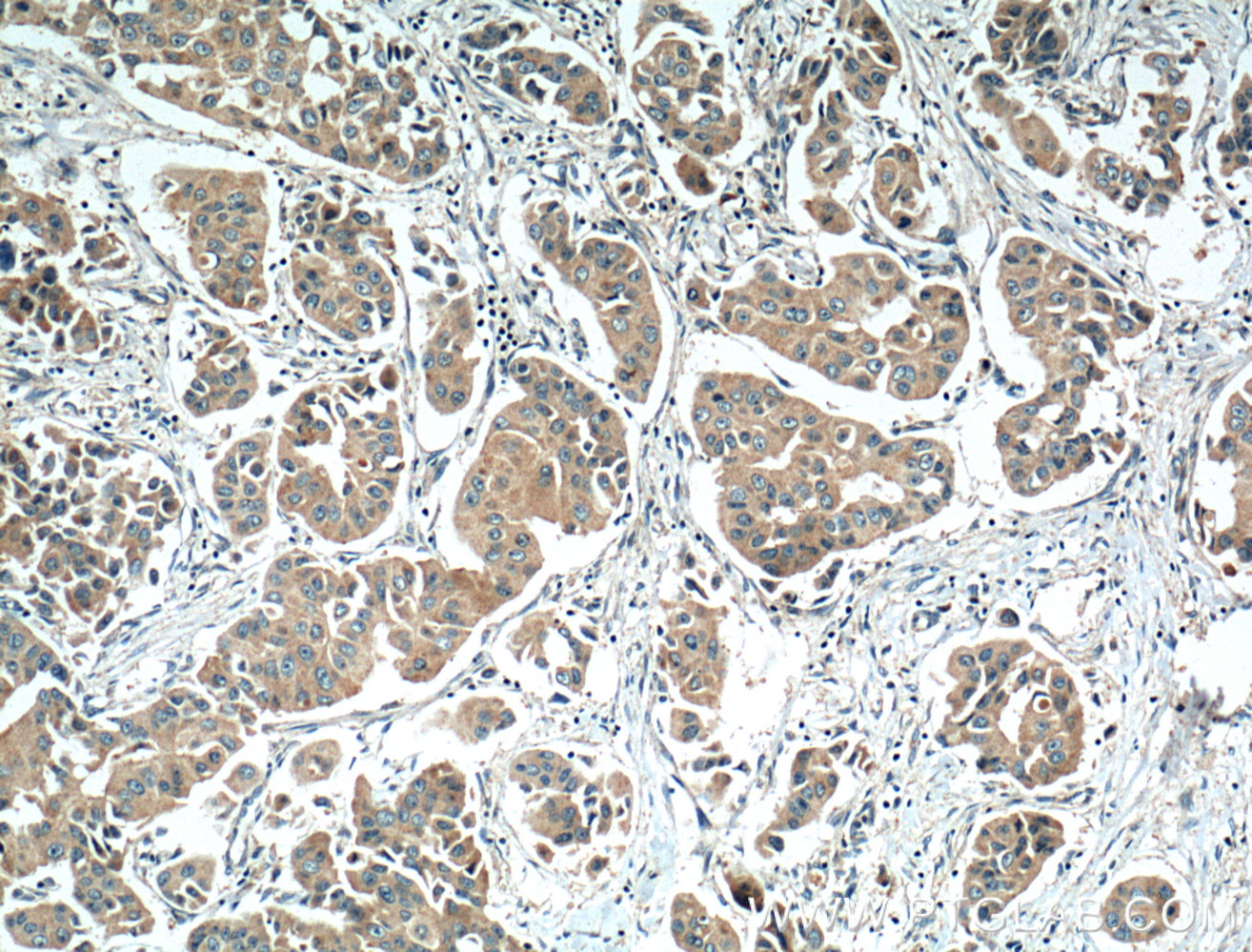 IHC staining of human breast cancer using 17354-1-AP