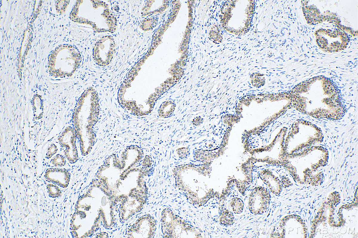IHC staining of human prostate cancer using 12238-1-AP
