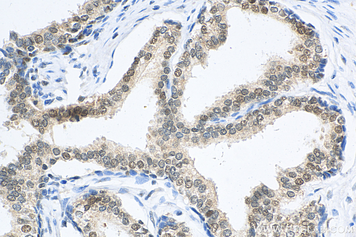 IHC staining of human prostate cancer using 12238-1-AP