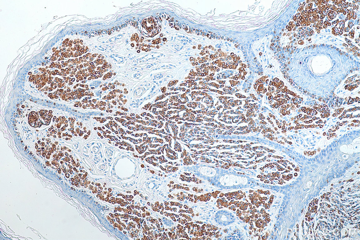 IHC staining of human malignant melanoma using 18472-1-AP
