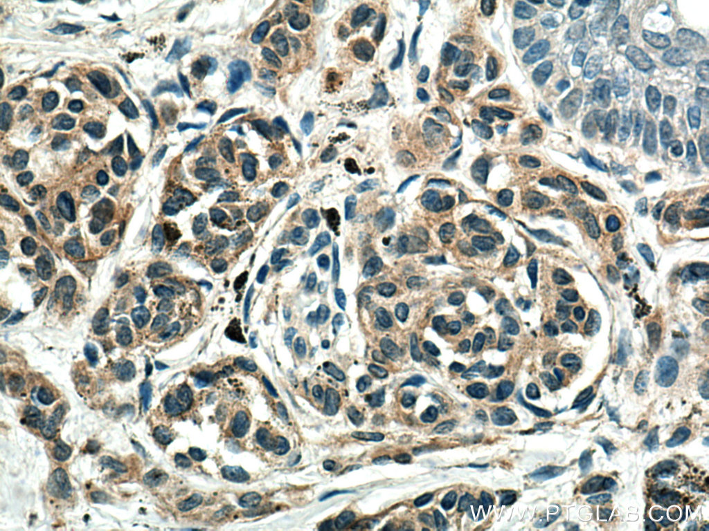 IHC staining of human malignant melanoma using 60348-1-Ig (same clone as 60348-1-PBS)