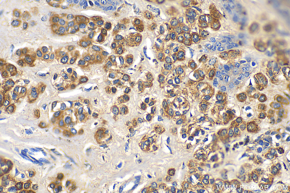 IHC staining of human malignant melanoma using 60348-1-Ig