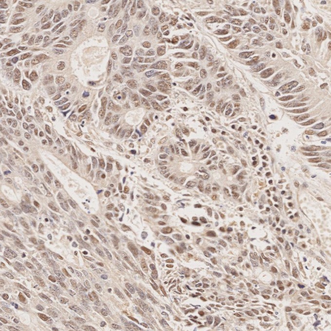 IHC staining of human colorectal cancer using 60822-2-Ig IHC staining of human colorectal cancer using 60822-2-Ig