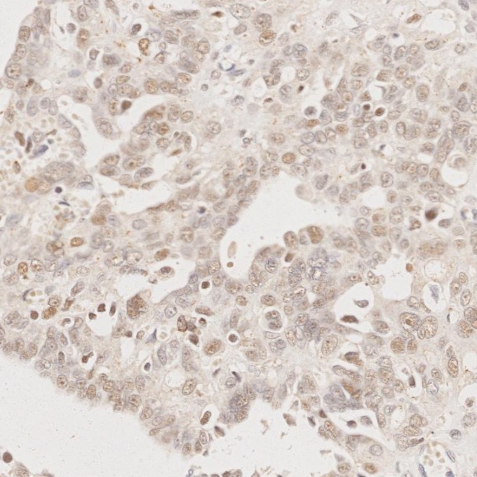 IHC staining of human ovary cancer using 60822-2-Ig IHC staining of human ovary cancer using 60822-2-Ig