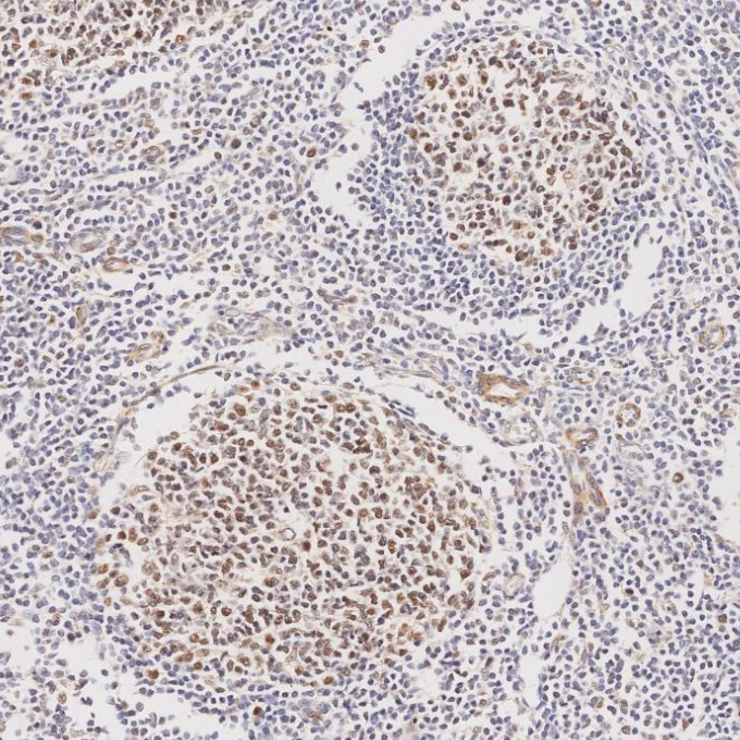 IHC staining of human tonsillitis using 60822-2-Ig IHC staining of human tonsillitis using 60822-2-Ig