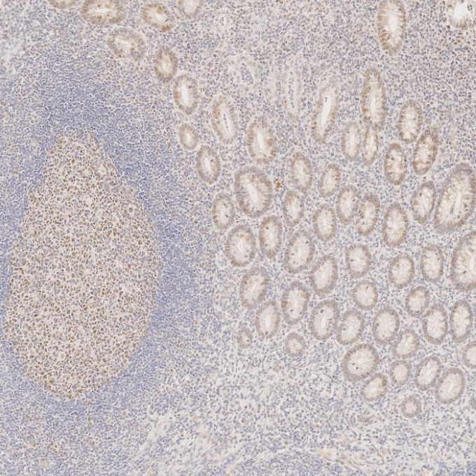 IHC staining of human appendicitis using 60822-2-Ig IHC staining of human appendicitis using 60822-2-Ig