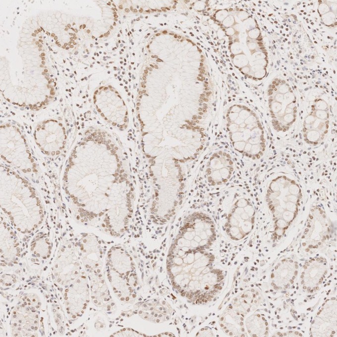 IHC staining of human stomach cancer using 60822-2-Ig IHC staining of human stomach cancer using 60822-2-Ig