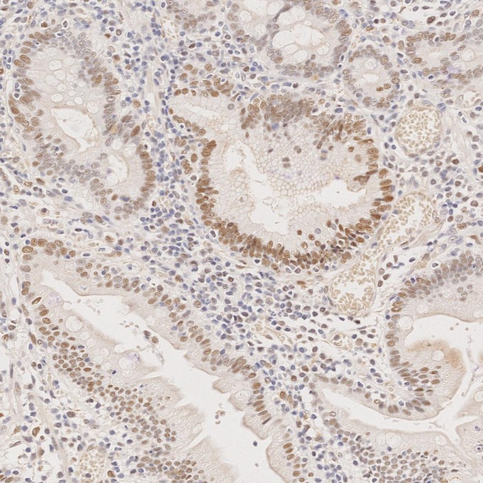 IHC staining of human stomach cancer using 60822-2-Ig IHC staining of human stomach cancer using 60822-2-Ig