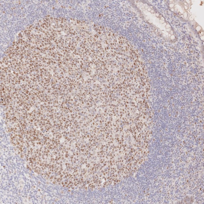 IHC staining of human appendicitis using 60822-2-Ig IHC staining of human appendicitis using 60822-2-Ig