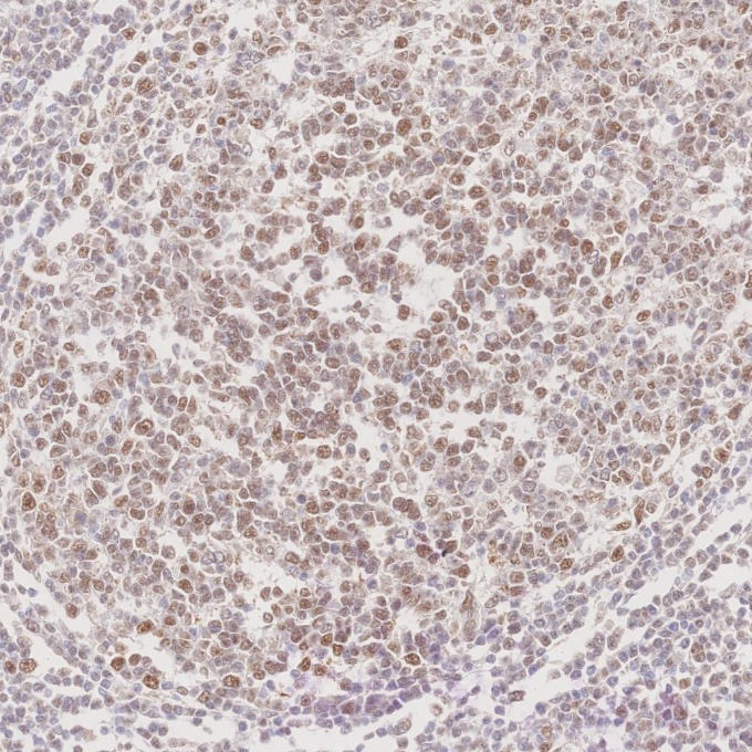 IHC staining of human tonsillitis using 60822-2-Ig IHC staining of human tonsillitis using 60822-2-Ig