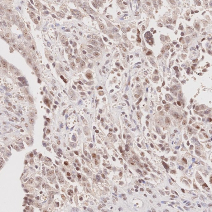 IHC staining of human ovary cancer using 60822-2-Ig IHC staining of human ovary cancer using 60822-2-Ig