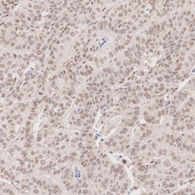 IHC staining of human stomach cancer using 60822-2-Ig IHC staining of human stomach cancer using 60822-2-Ig