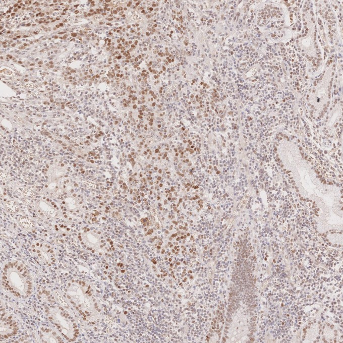 IHC staining of human stomach cancer using 60822-2-Ig IHC staining of human stomach cancer using 60822-2-Ig