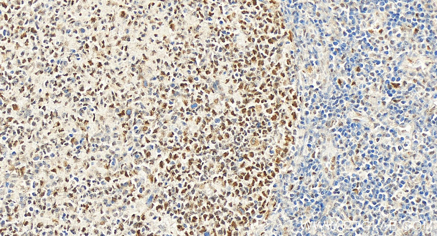 IHC staining of Human tonsillitis using 60822-2-Ig (same clone as 60822-2-PBS)