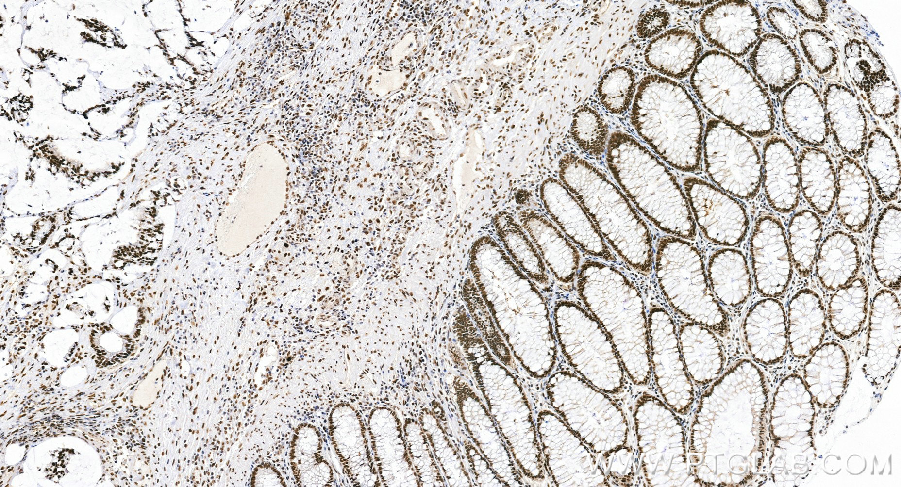 IHC staining of human colon cancer using 84208-7-RR (same clone as 84208-7-PBS) IHC staining of human colon cancer using 84208-7-RR (same clone as 84208-7-PBS)