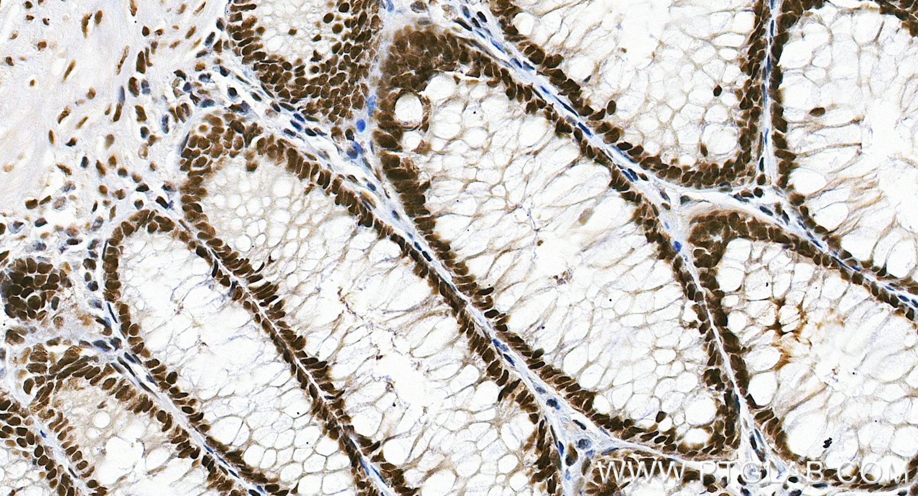 IHC staining of human colon cancer using 84208-7-RR (same clone as 84208-7-PBS) IHC staining of human colon cancer using 84208-7-RR (same clone as 84208-7-PBS)