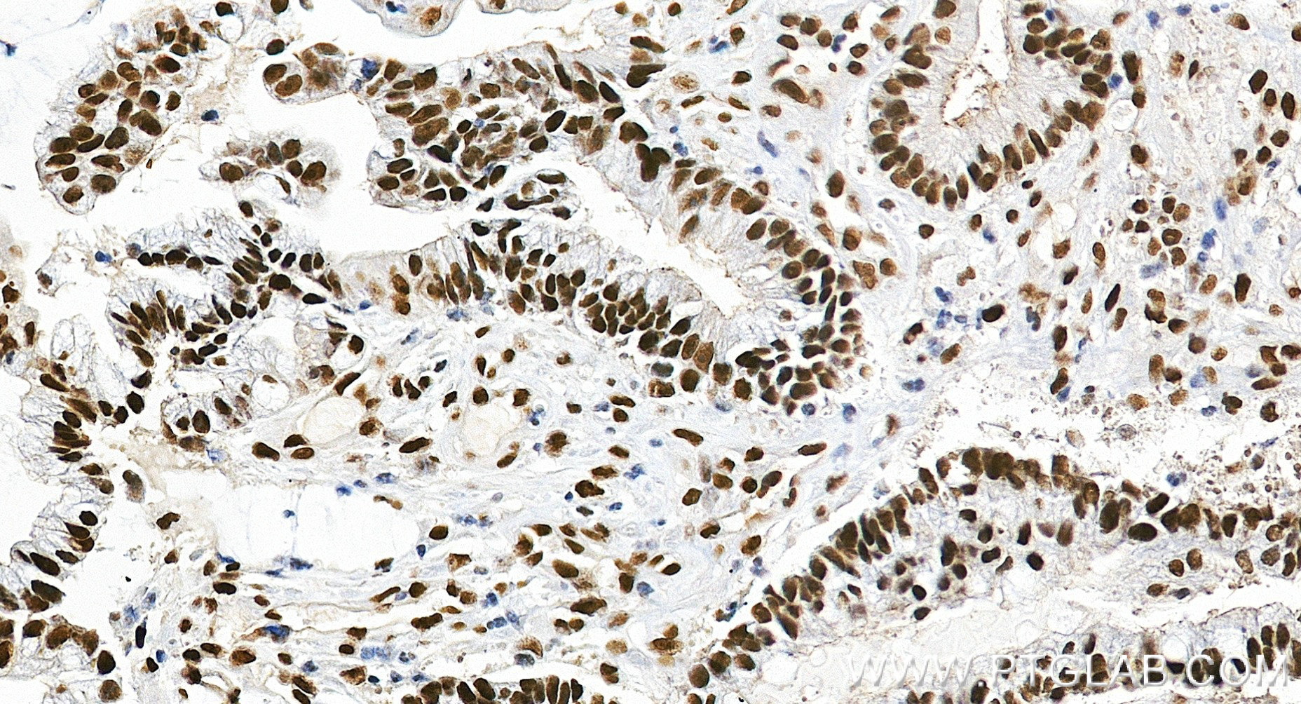 IHC staining of human colon cancer using 84208-7-RR (same clone as 84208-7-PBS) IHC staining of human colon cancer using 84208-7-RR (same clone as 84208-7-PBS)