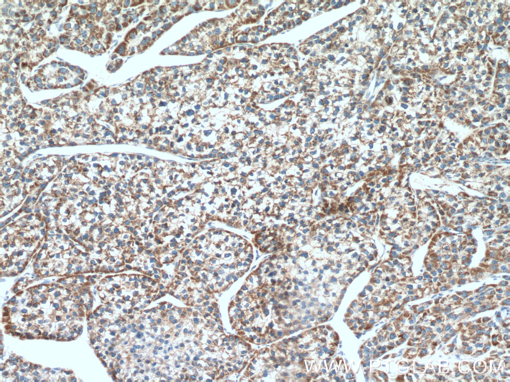 IHC staining of human liver cancer using 21066-1-AP