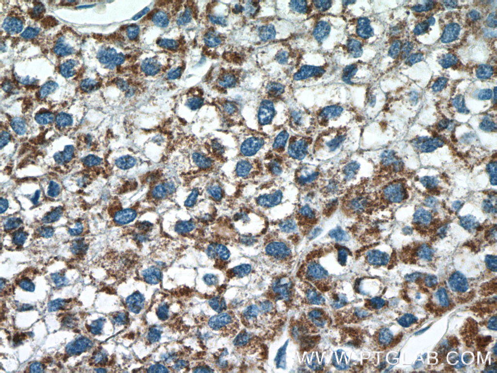 IHC staining of human liver cancer using 21066-1-AP