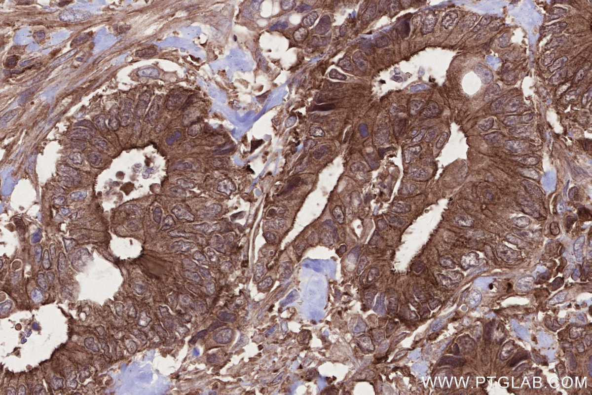 IHC staining of human rectal cancer using 66675-1-Ig