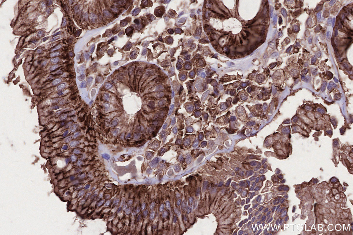 IHC staining of human rectal cancer using 66675-1-Ig