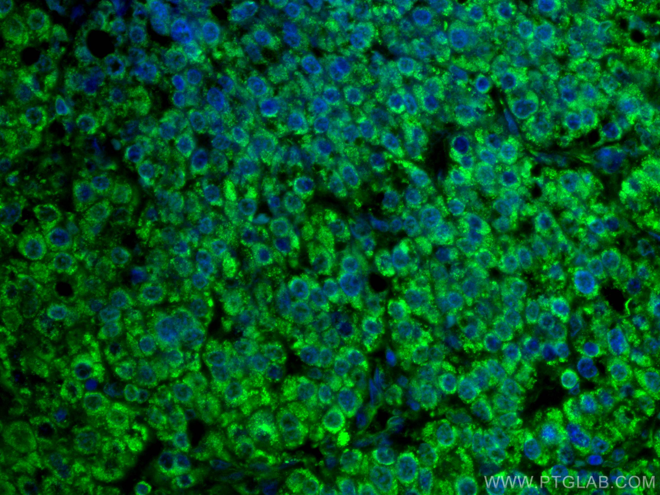 IF Staining of human liver cancer using CL488-66675