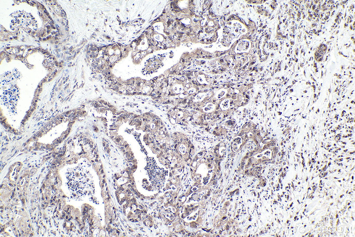 IHC staining of human pancreas cancer using 14540-1-AP