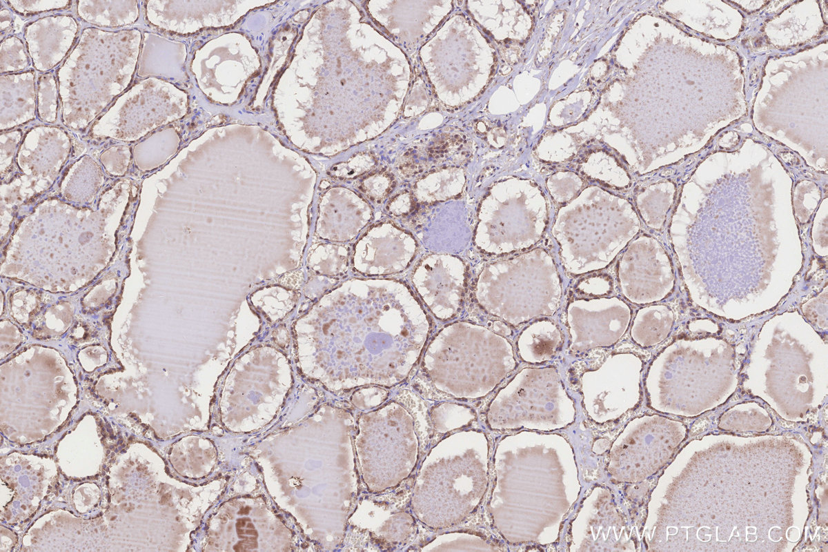IHC staining of human thyroid cancer using 20292-1-AP IHC staining of human thyroid cancer using 20292-1-AP