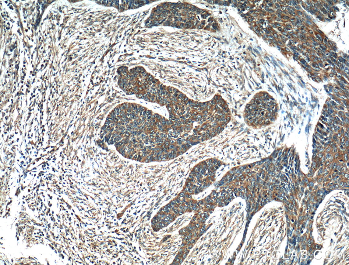 IHC staining of human skin cancer using 10338-1-AP