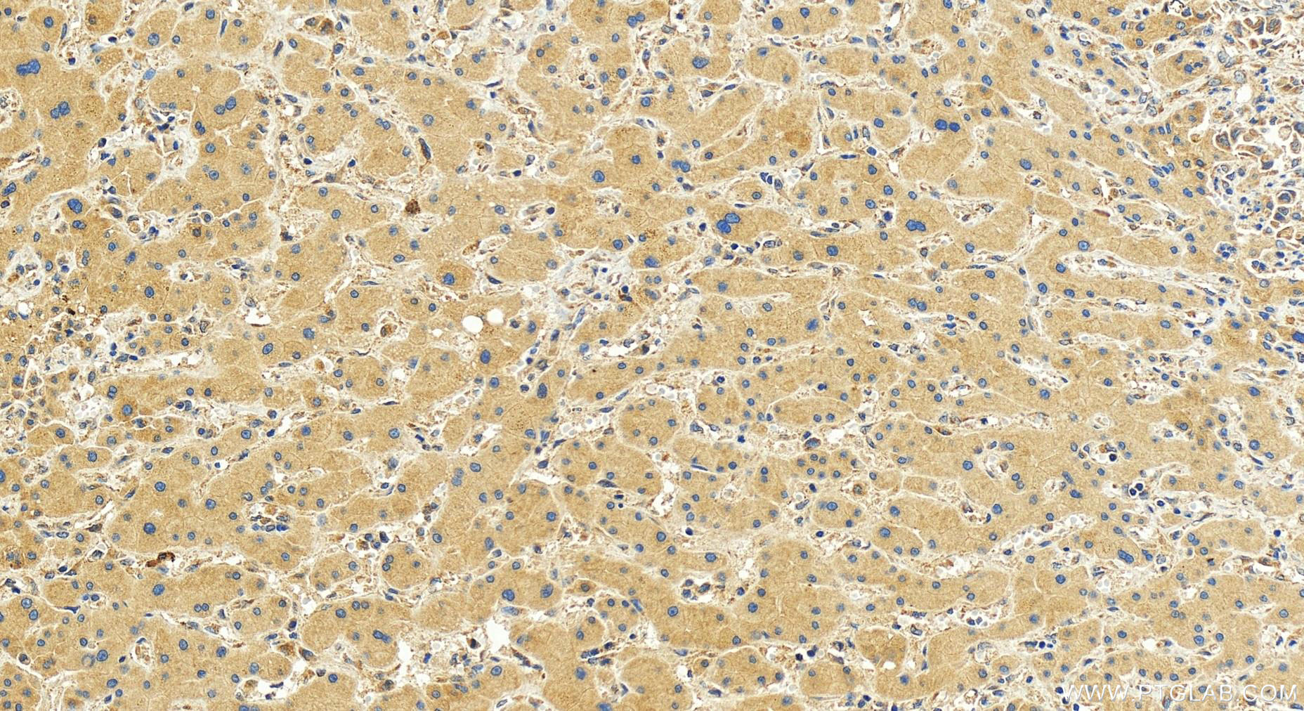 IHC staining of human intrahepatic cholangiocarcinoma using 30618-1-AP