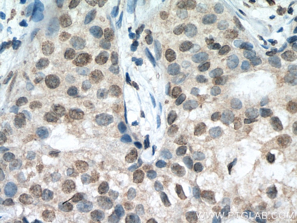 IHC staining of human breast cancer using 67042-1-Ig (same clone as 67042-1-PBS)