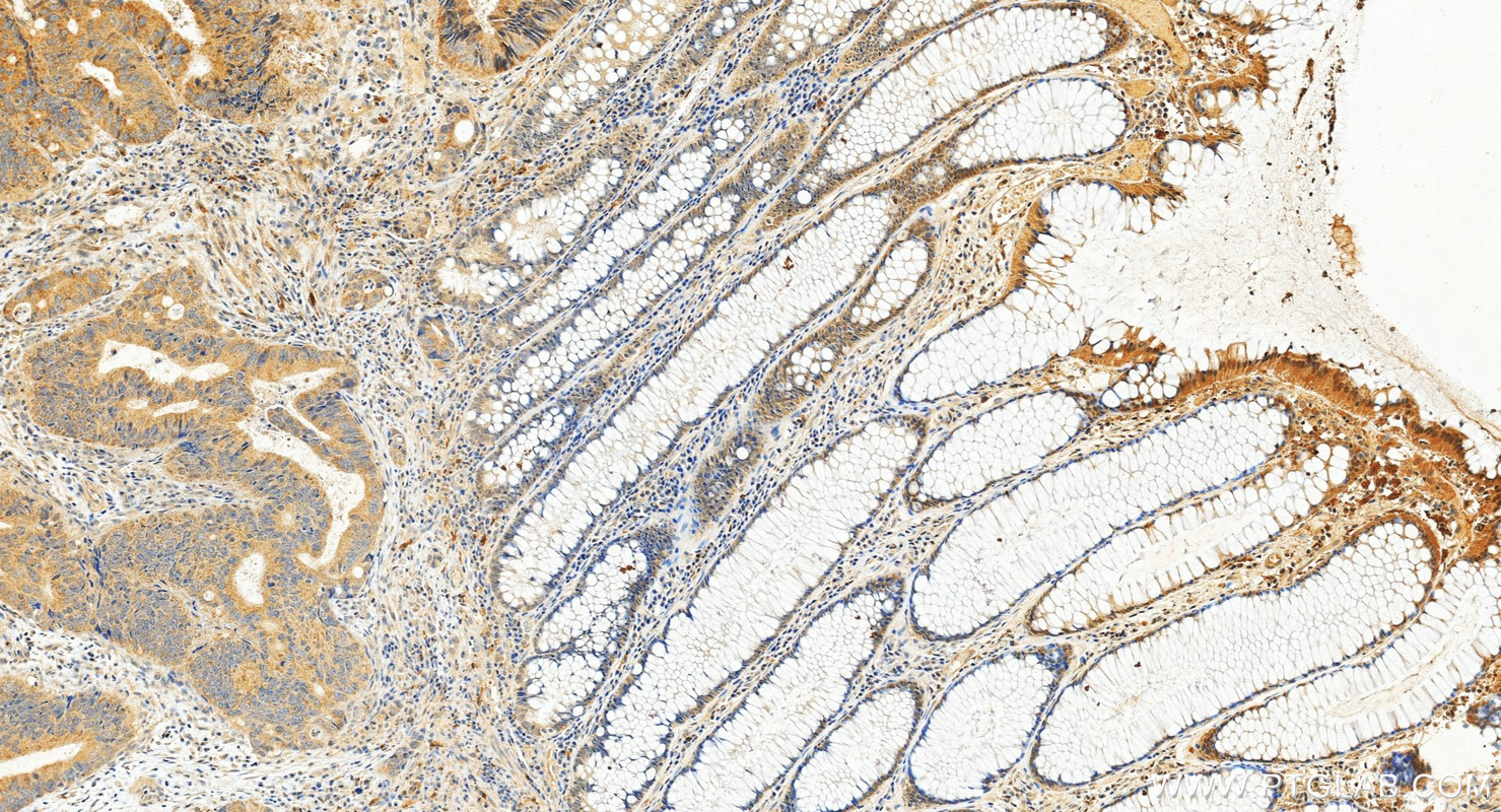 IHC staining of human colon cancer using 13256-1-AP IHC staining of human colon cancer using 13256-1-AP