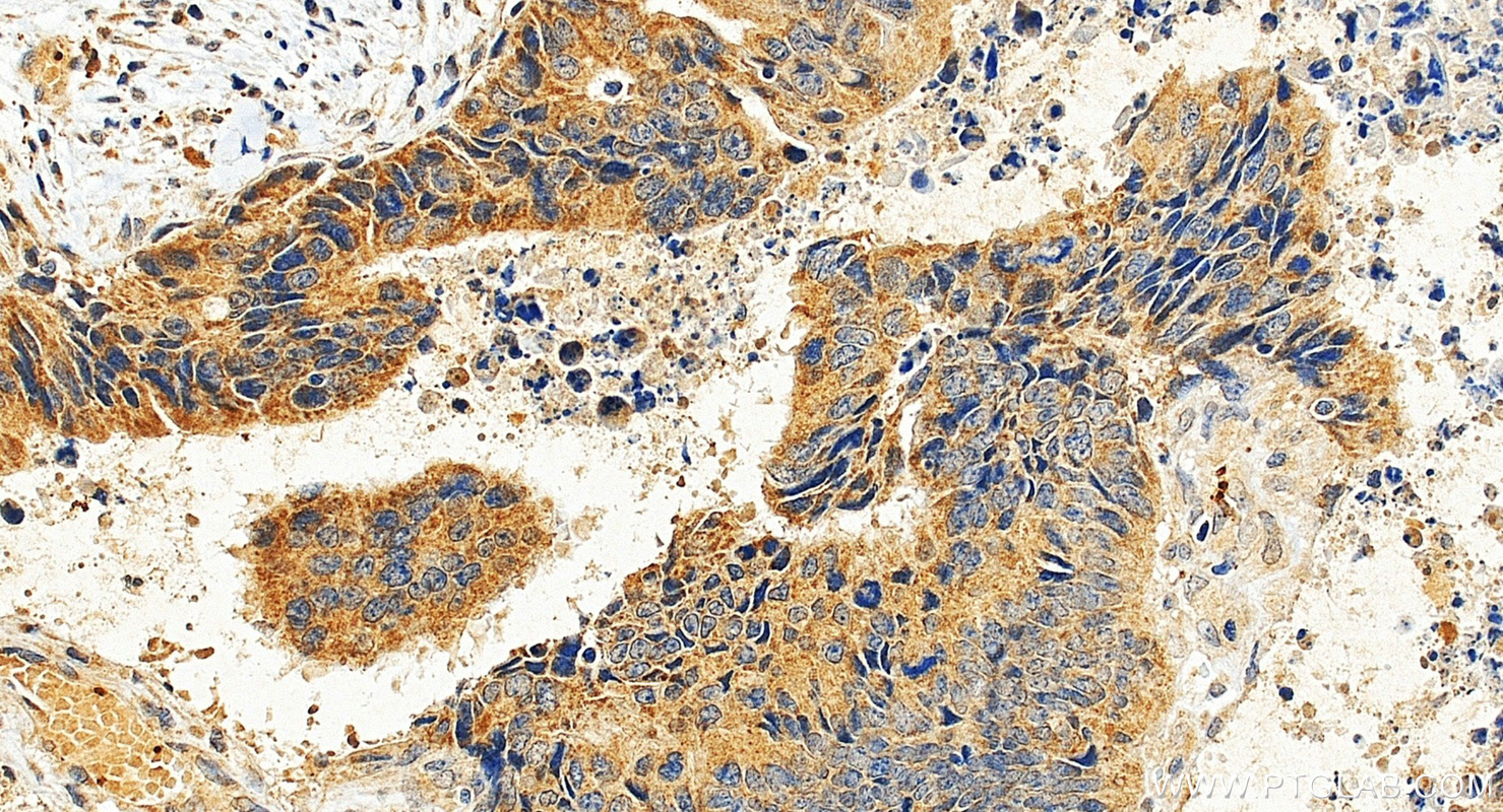 IHC staining of human colon cancer using 13256-1-AP IHC staining of human colon cancer using 13256-1-AP