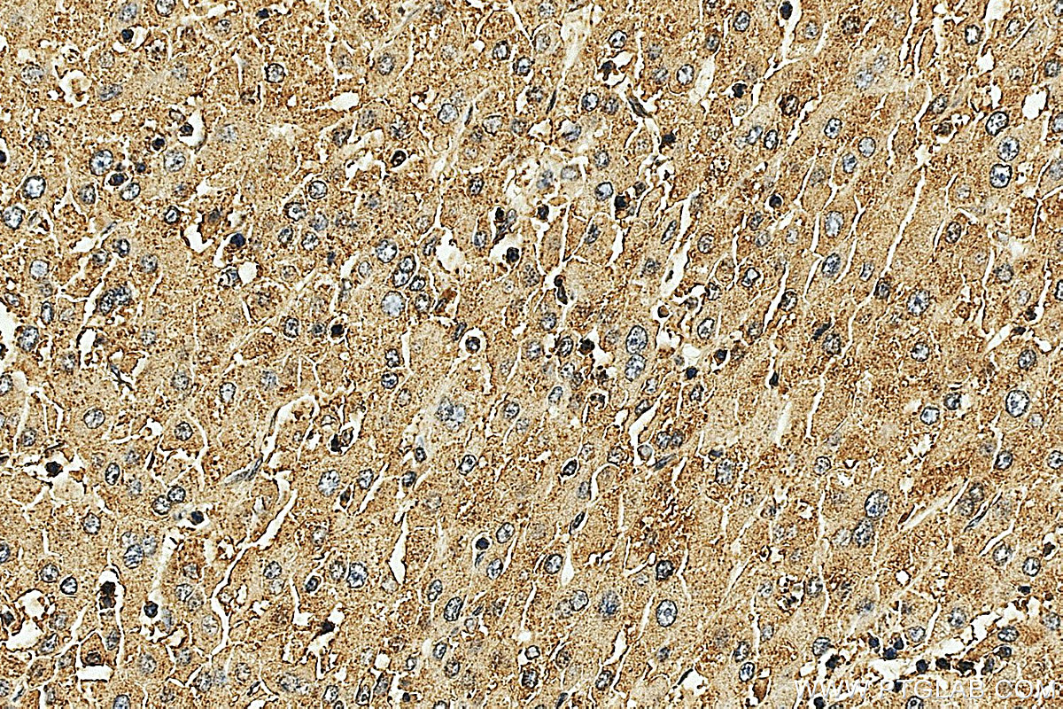 IHC staining of human liver cancer using 33703-1-AP