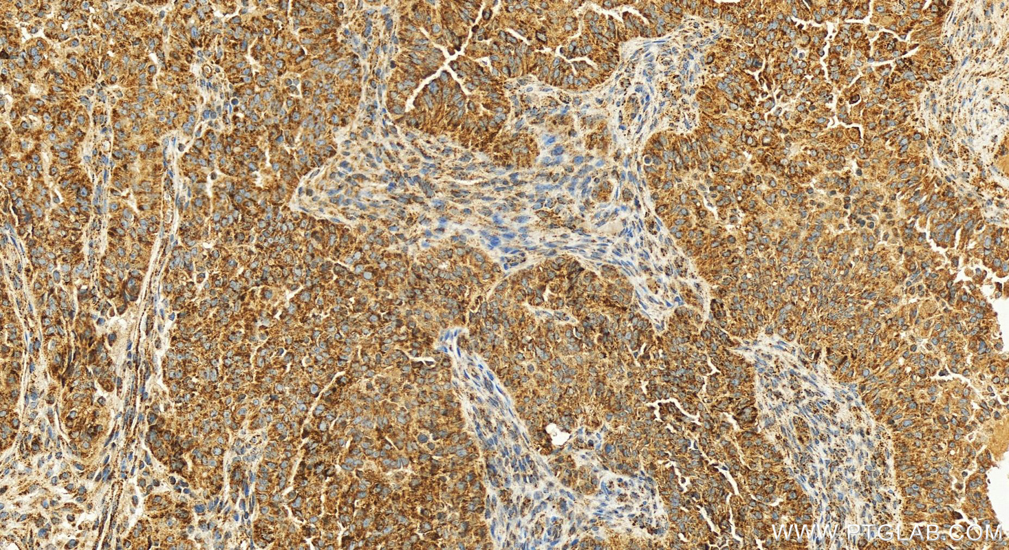 IHC staining of human ovarian cancer using 11137-1-AP