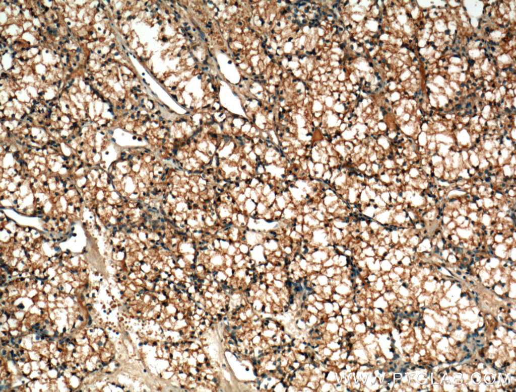 IHC staining of human renal cell carcinoma using 60034-3-Ig (same clone as 60034-3-PBS)
