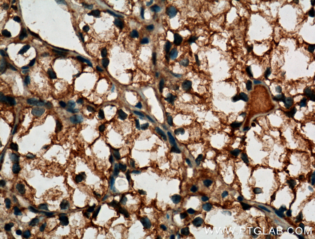 IHC staining of human renal cell carcinoma using 60034-3-Ig (same clone as 60034-3-PBS)