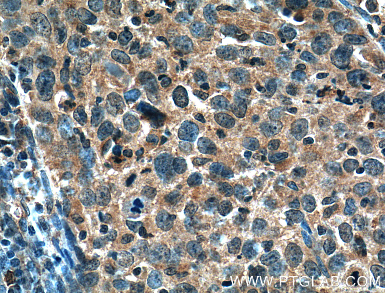 IHC staining of human cervical cancer using 26585-1-AP