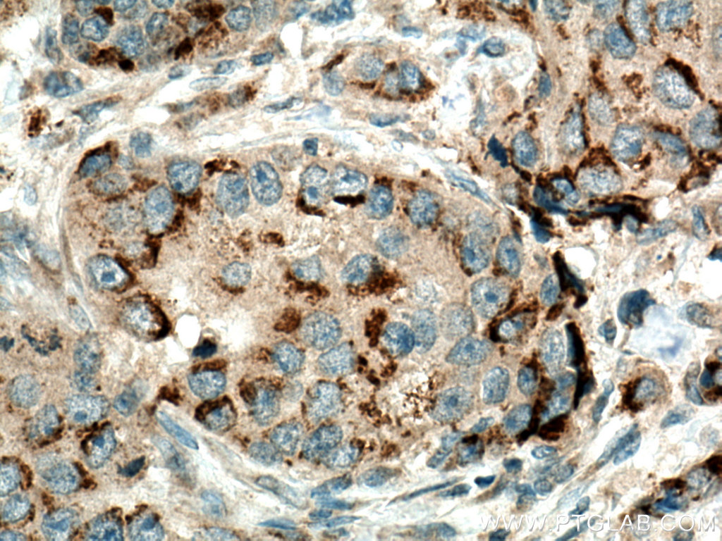 IHC staining of human breast cancer using 22989-1-AP