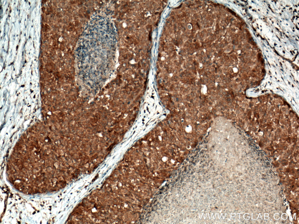 IHC staining of human breast cancer using 18165-1-AP