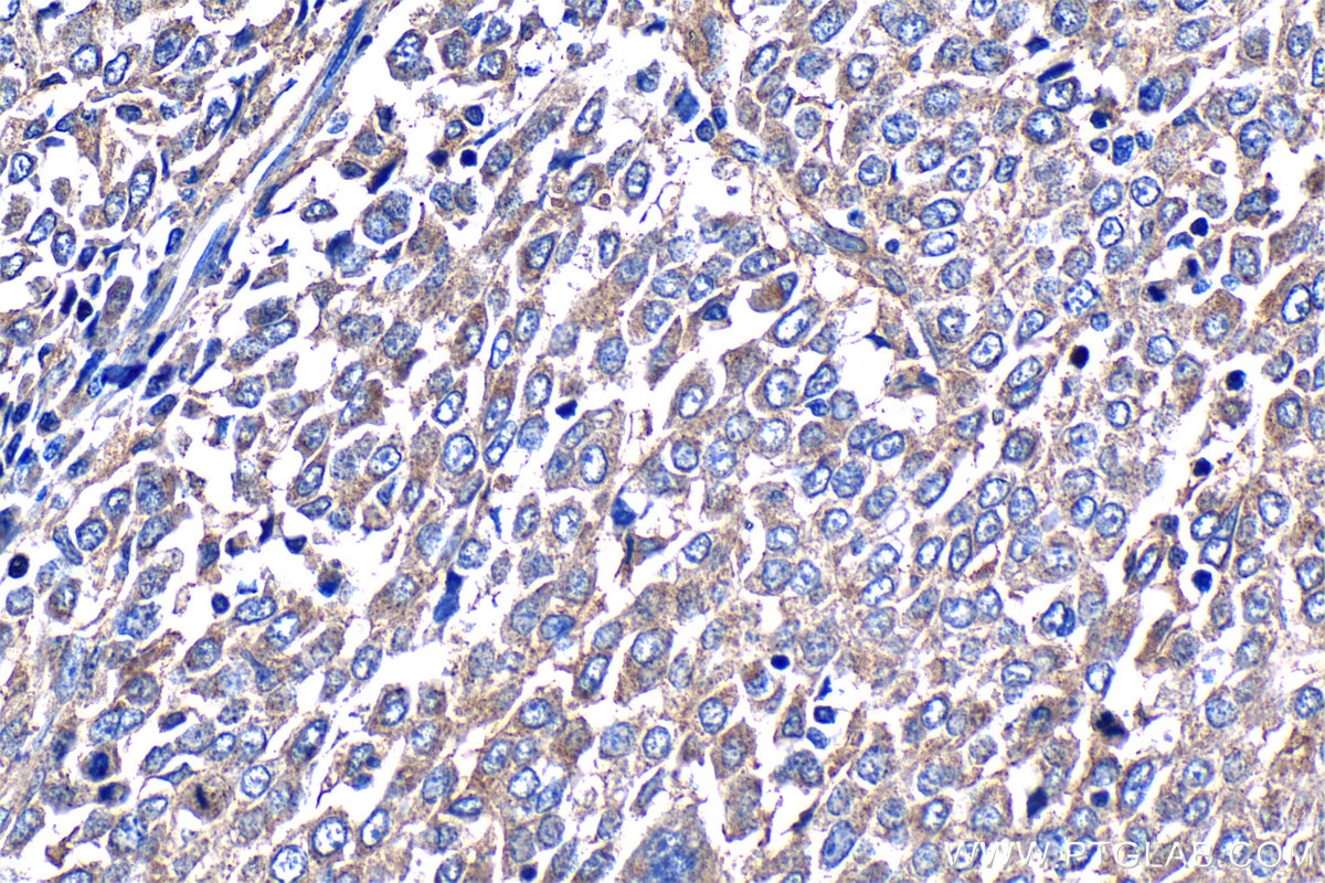 IHC staining of human ovary tumor using 14552-1-AP