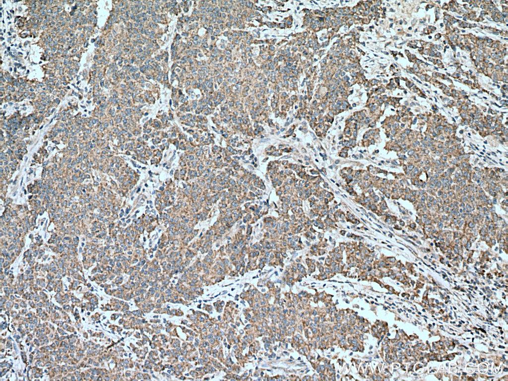 IHC staining of human stomach cancer using 28429-1-AP