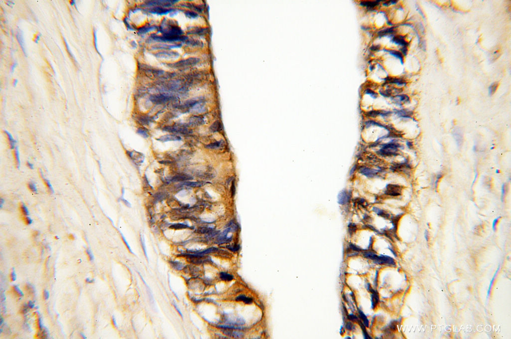 IHC staining of human breast cancer using 17873-1-AP