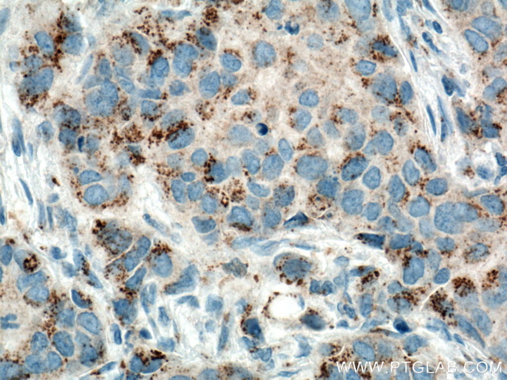 IHC staining of human breast cancer using 66338-1-Ig