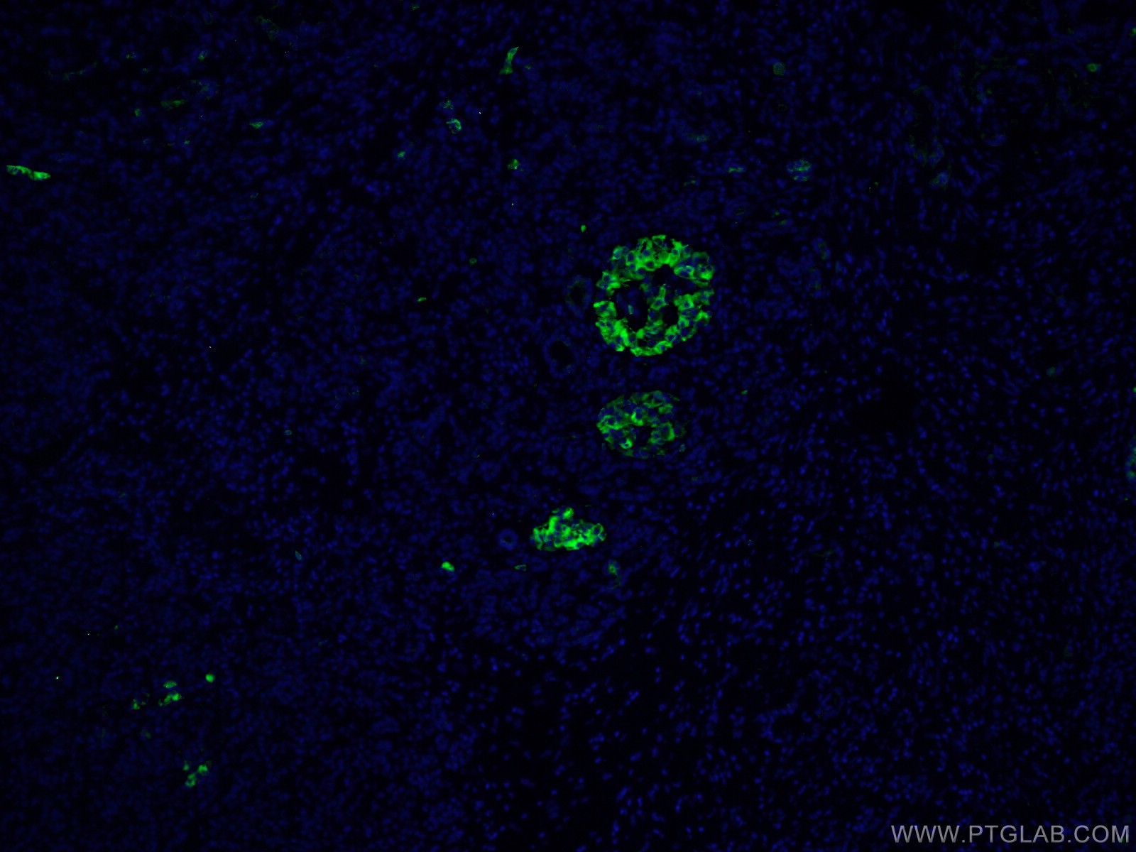 IF Staining of human pancreas cancer using 10374-2-AP