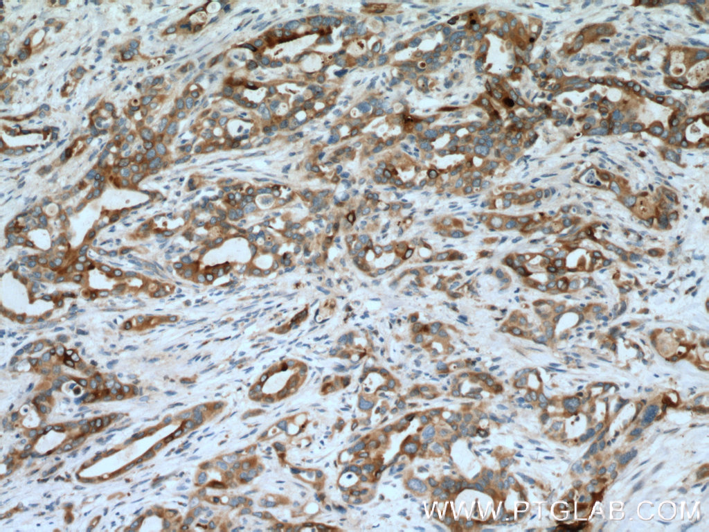 IHC staining of human pancreas cancer using 10374-2-AP