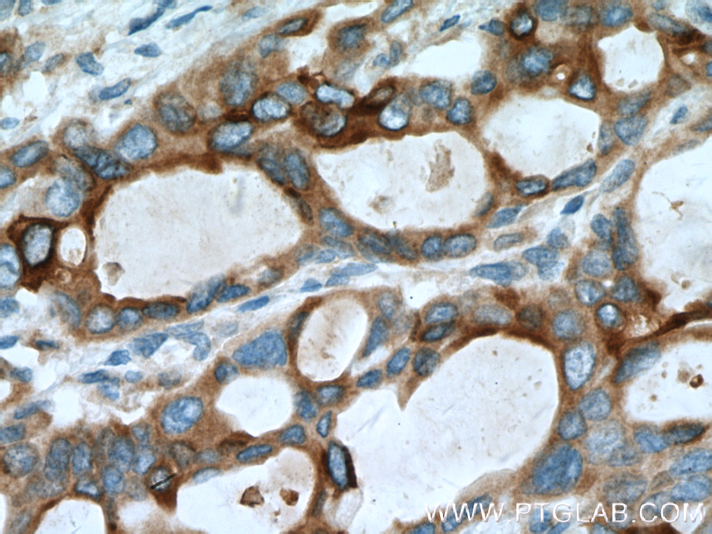 IHC staining of human pancreas cancer using 10374-2-AP